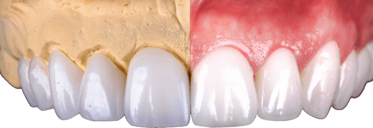 https://drginamillan.com/wp-content/uploads/2024/06/luxur-smile-resin-porcelain-veneers-768x264.png